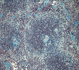fibrose2