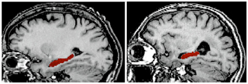 Alzheimer