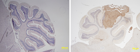 cervelet_medulloblastome