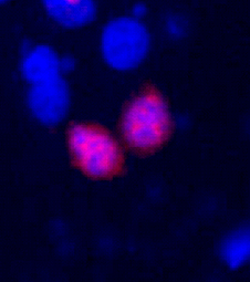 Photo Cancer du sein 1