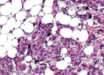 Photo_Cancer la obesidad
