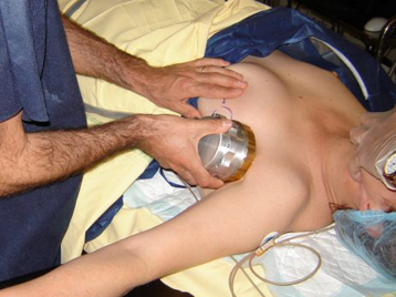 Photo cancer du sein 1