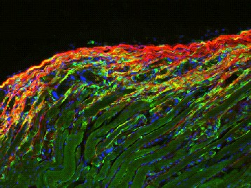 fibrose