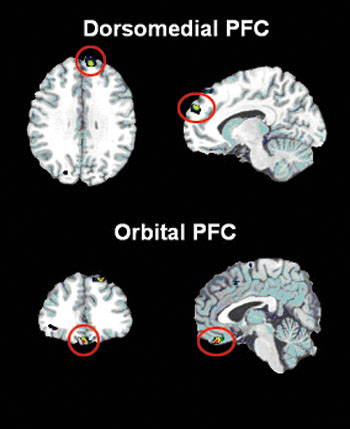 Mpfc Brain