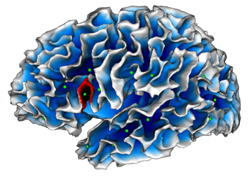 Autism_brain_map