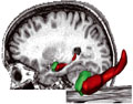 cerveau alzheimer